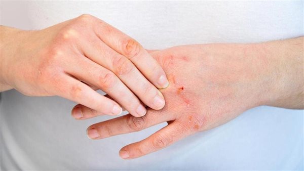 علاج جفاف الجلد لمرضى