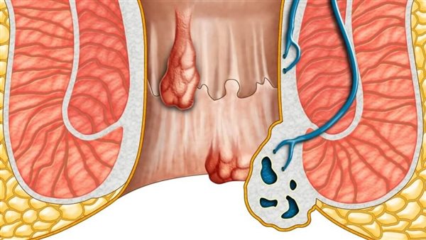 علاج شرخ الإمساك