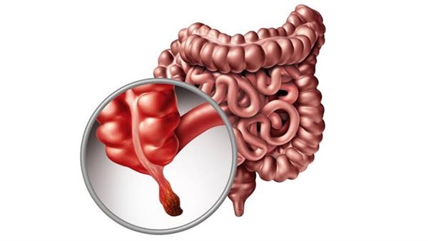 علاج الزائدة الدودية