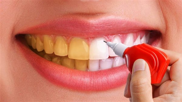 تبييض الأسنان.. أرشيفية