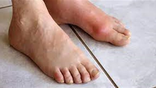 أعراض النقرس في الرجل