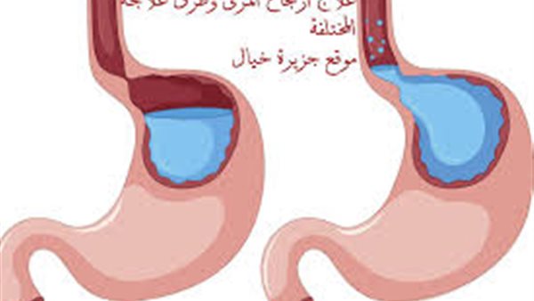 أسباب الارتجاع المريئي