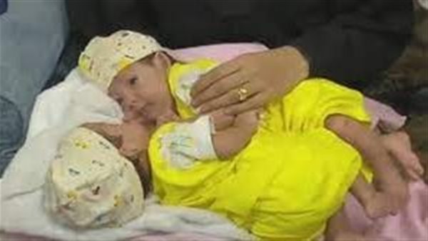 التوأم اليمني مودة