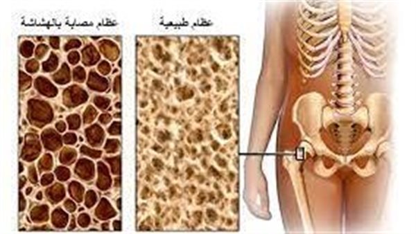 هل هشاشة العظام مرض