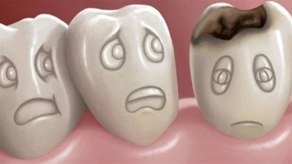 أعراض تسوس الأسنان