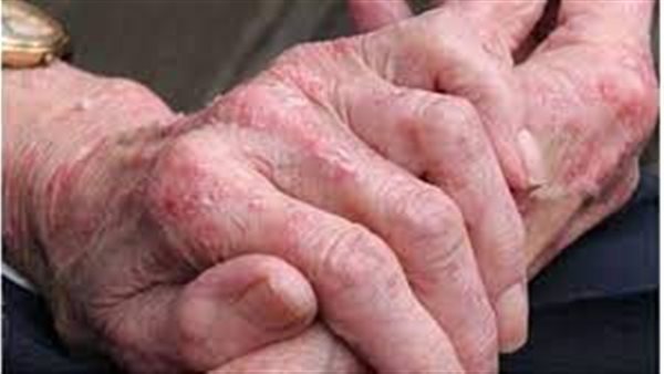 أعراض الذئبة الحمراء