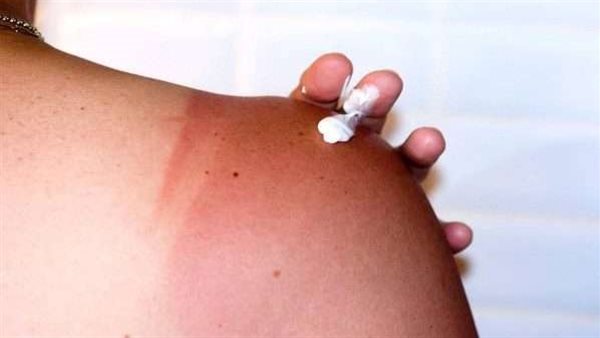 أعراض حروق الشمس