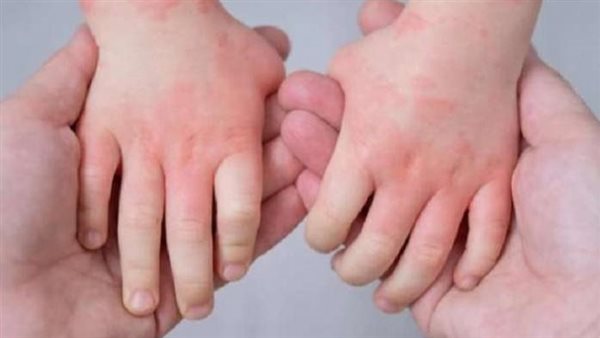 أعراض إنفلونزا الطماطم