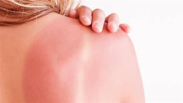 علاج حروق الشمس بزيت