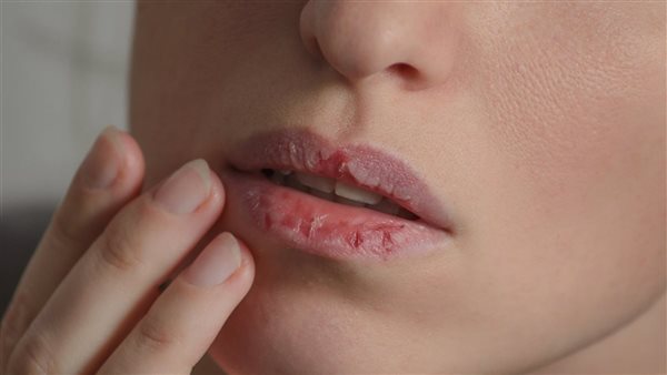 أمراض مرتبط بالشفاه