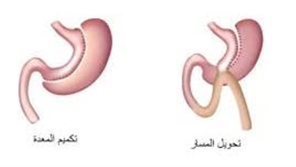 الفرق بين تكميم المعدة