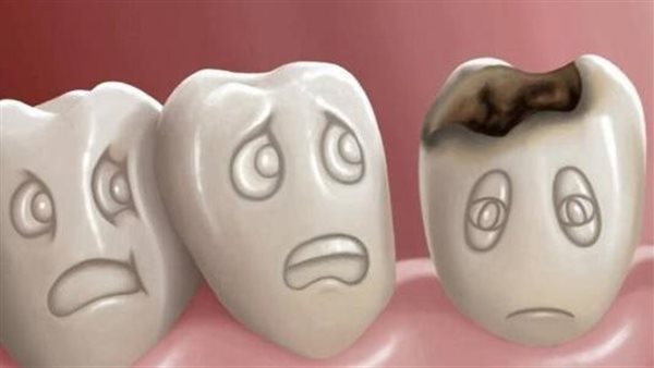 علاج تسوس الأسنان