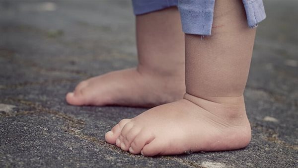 أنواع تقوس الساقين
