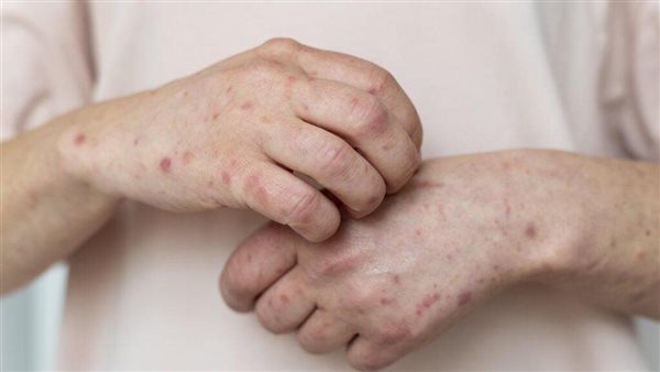 أعراض جدري القرود