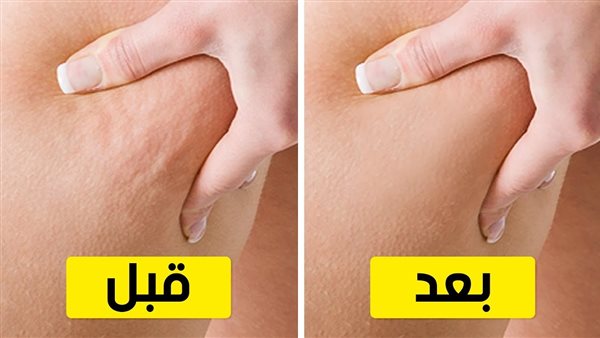 ما هو السيلوليت وكيفية