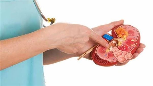 أعراض نزول الحصوة