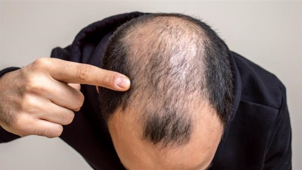 علاج تساقط الشعر