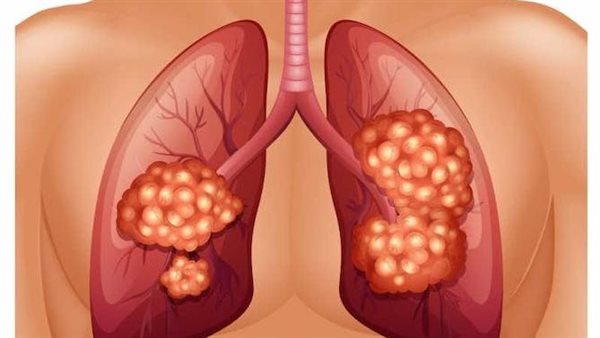أعراض وعلاج سرطان