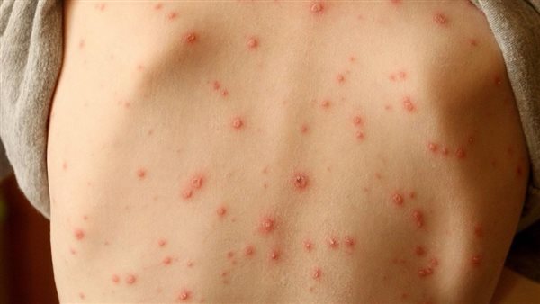 أعراض مرض الإيدز