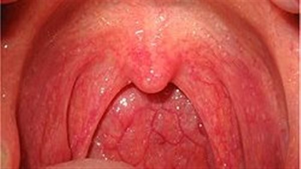 أعراض التهابات الحلق