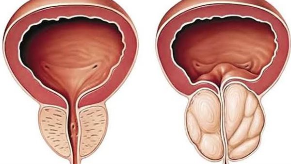 أعراض التهاب البروستاتا