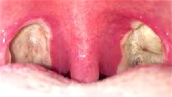 سبب استئصال اللوز