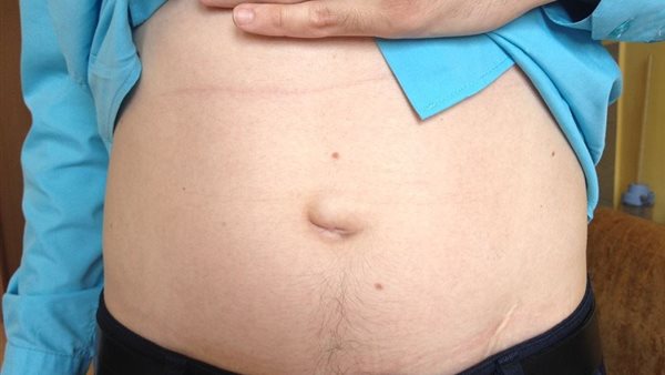 أسباب وأعراض وعلاج