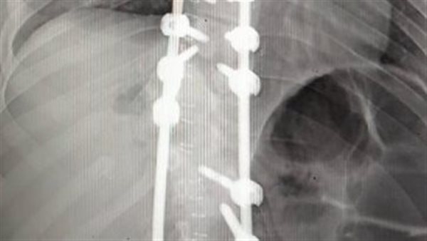 إجراء خامس عملية
