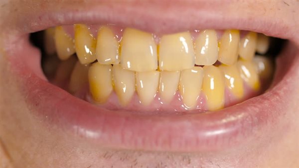 علاج اصفرار الأسنان