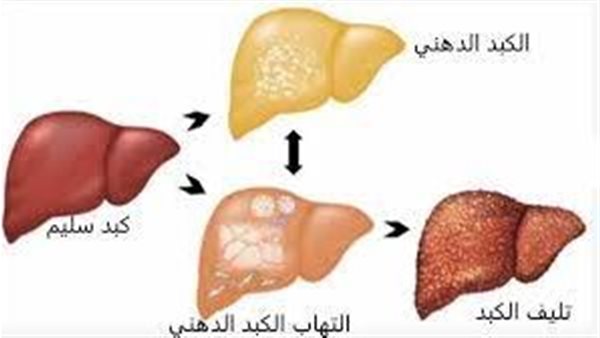 مراحل الكبد الدهني