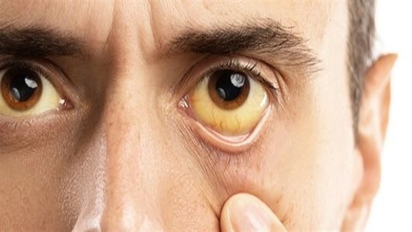أعراض التهاب الكبد B