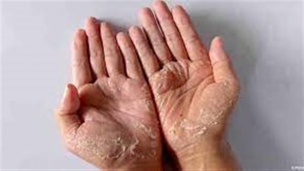 علاج تقشر باطن اليدين