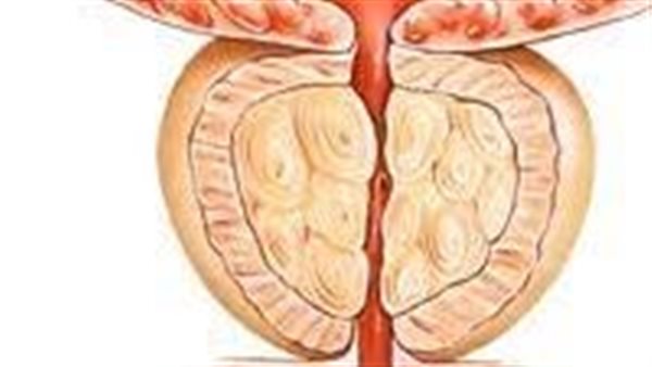 أعراض تضخم البروستاتا