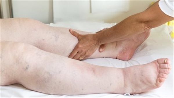 ما علاج الأملاح؟
