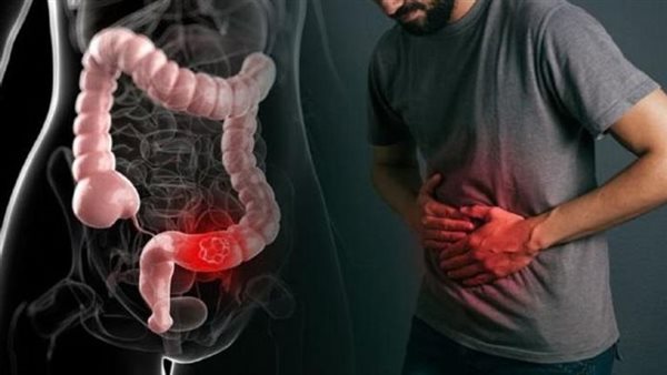 علاج الامساك المزمن