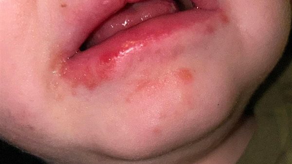 مرض Strep A