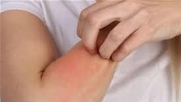 ما هي اسباب حساسية الجلد المفاجئة؟