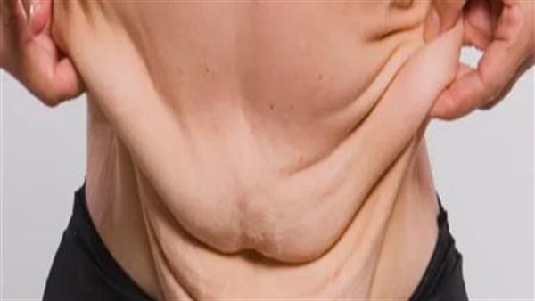 هل يمكن شد البطن