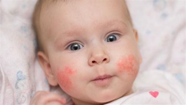 أعراض حساسية الطعام