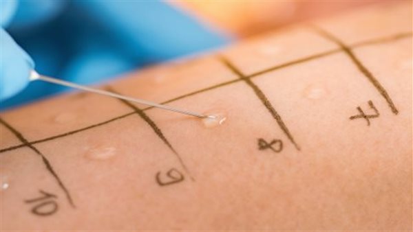 أنواع اختبارات الحساسية