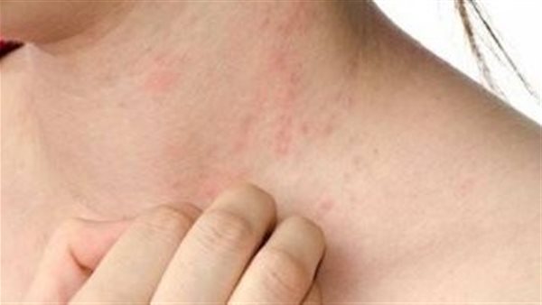 أعراض حساسية القمح