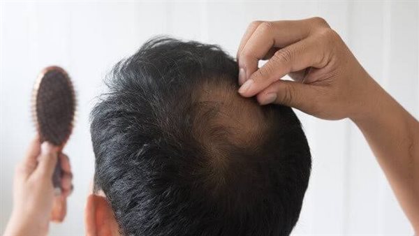 متى يتوقف تساقط الشعر