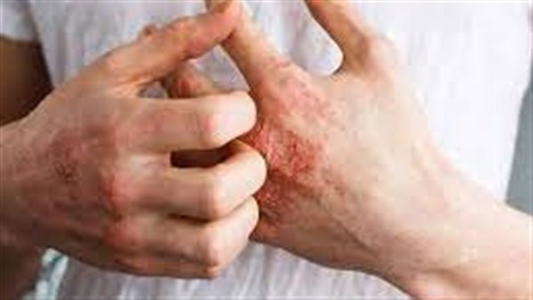 أعراض مقاومة الأنسولين