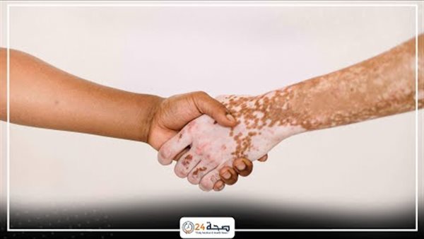مرض البهاق