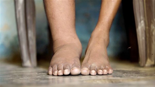 علاج داء الفيل