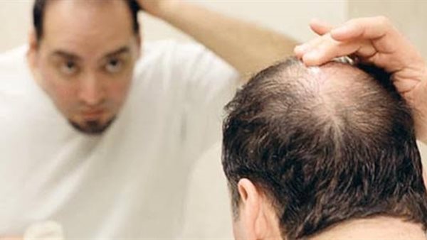 تساقط الشعر