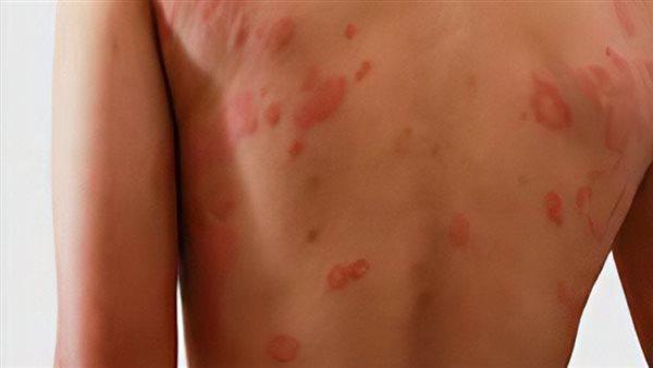 أعراض حساسية الدواء