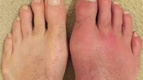 أعراض الإصابة بالنقرس