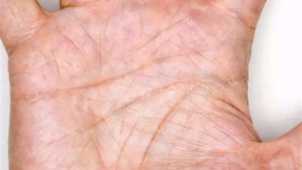 اعراض ارتفاع الكوليسترول