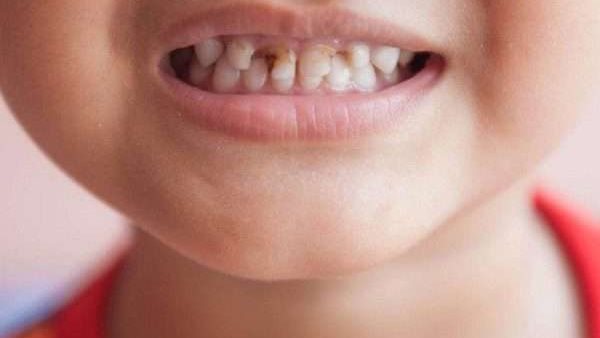 فيتامين لتقوية أسنان